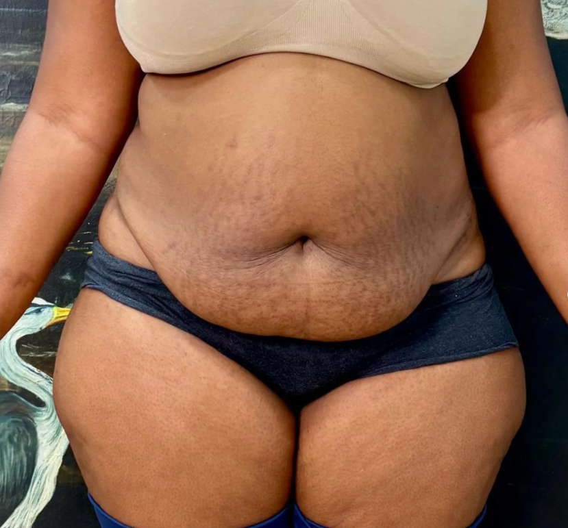 Abdominoplasty Before